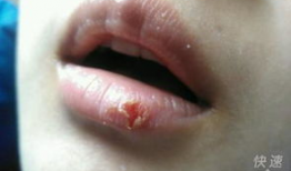 吃瓜后嘴角发红
